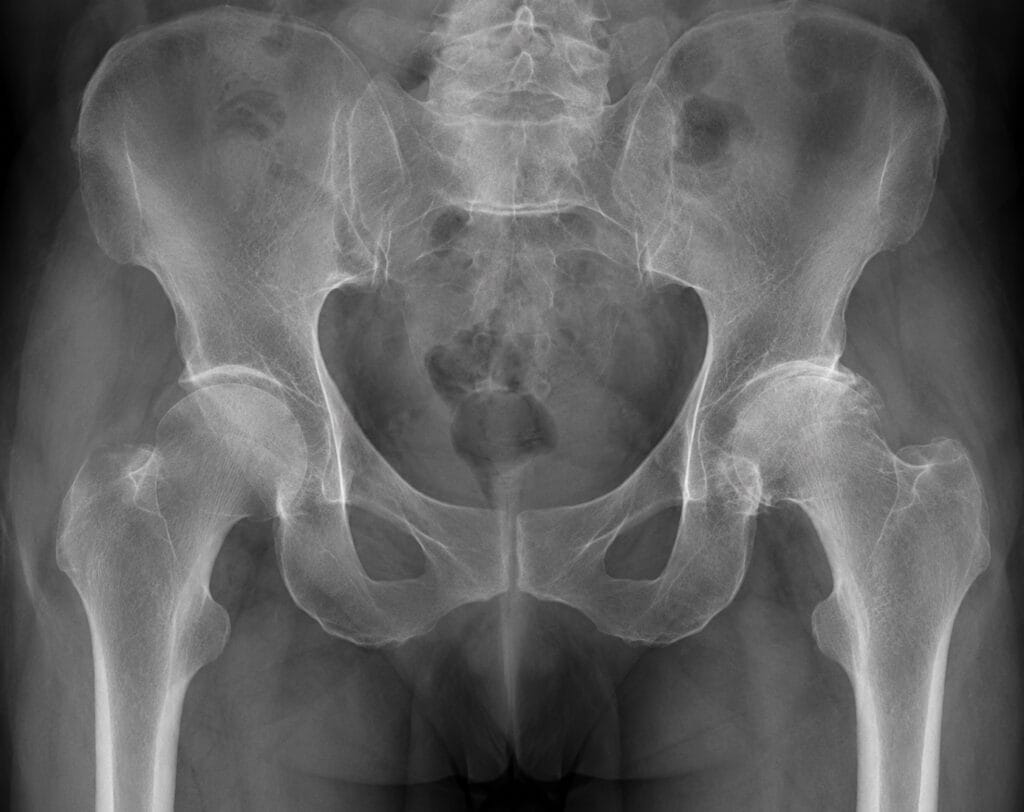Radiografia di un'anca con coxartrosi